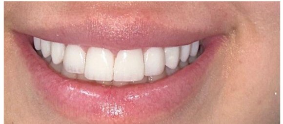 Depois das lentes em resina